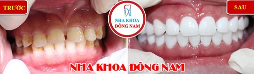 Bọc răng sứ cho răng thưa và xỉn màu