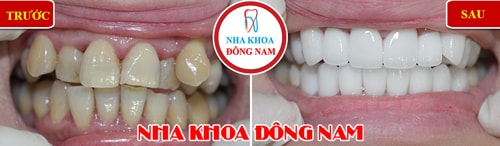 Bọc răng sứ cho răng bị vàng và lộn xộn