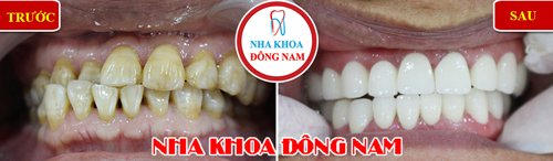 bọc răng sứ 2 hàm cho răng bị nhiễm kháng sinh