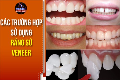 Các Trường Hợp Sử Dụng Răng Sứ Veneer Trong Nha Khoa