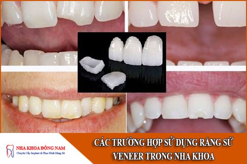 các trường hợp sử dụng răng sứ veneer trong nha khoa