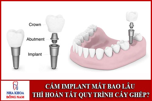 Cắm ghép Implant mất thời gian bao lâu