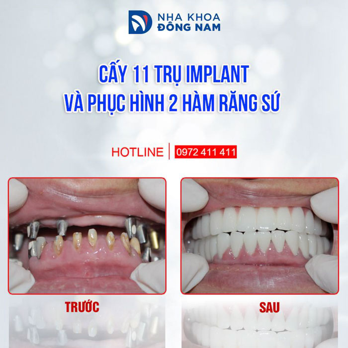 Cấy ghép Implant phục hình răng mất tối ưu