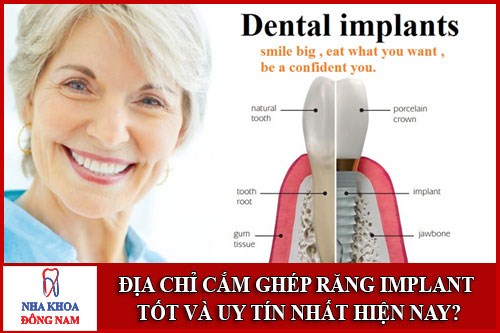 Địa chỉ cắm ghép implant tốt và uy tín nhất hiện nay