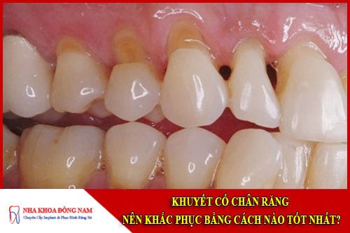 khuyết cổ chân răng nên khắc phục bằng cách nào tốt nhất
