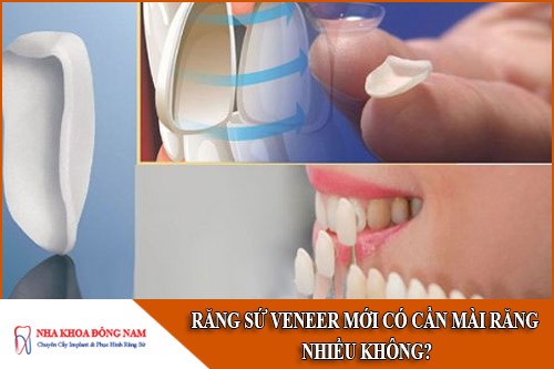 làm răng sứ veneer mới có cần mài răng nhiều không