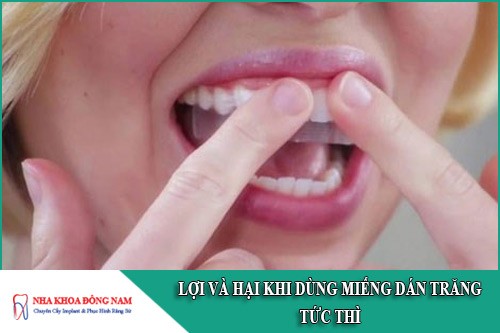 lợi và hại khi dùng miếng dán trắng răng tức thì