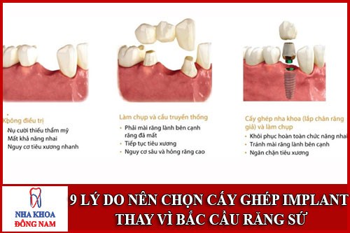 Lý do nên chọn cấy ghép Implant thay vì cầu răng sứ