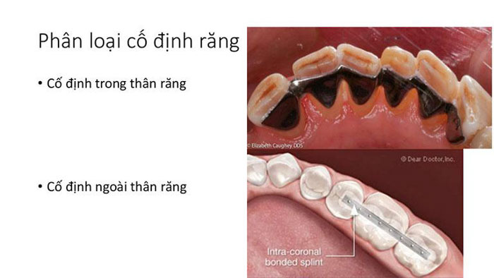 Nẹp cố định răng bị lung lay do va đập, chấn thương