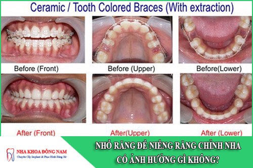 nhổ răng để niềng răng chỉnh nha có ảnh hưởng gì không