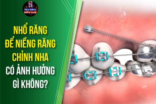 nhổ răng để niềng răng chỉnh nha có ảnh hưởng gì không