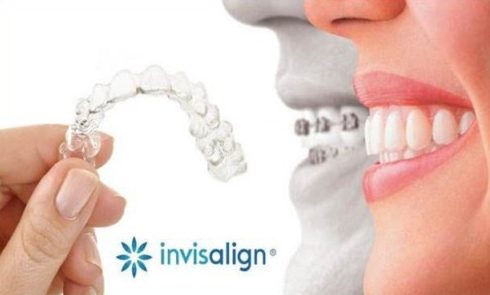 Niềng răng Invisalign trong bao lâu thời gian 1