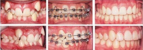 Niềng răng Invisalign trong bao lâu thời gian 5