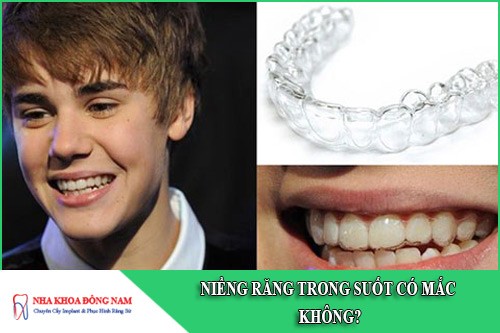 niềng răng trong suốt có mắc không