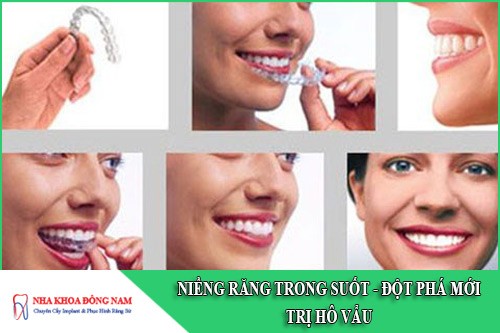 niềng răng trong suốt - giải pháp đột phá điều trị hô vẩu