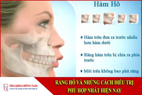 răng hô và những cách điều trị phù hợp nhất hiện nay