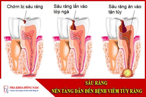 Sâu răng nền tảng của bệnh viêm tủy