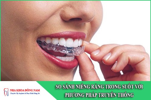 so sánh niềng răng trong suốt với phương pháp truyền thống