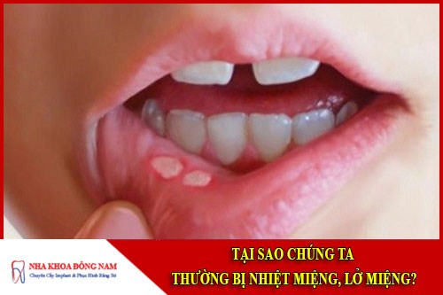 Tại sao chúng ta thường xuyên bị nhiệt miệng