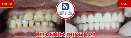 Tẩy trắng răng laser whitening mang lại hiệu quả tức thì không 13