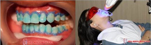 Tẩy trắng răng laser whitening mang lại hiệu quả tức thì không 6