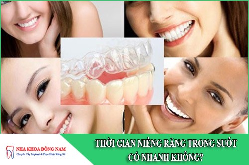 thời gian niềng răng trong suốt có nhanh không