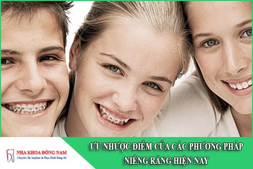ưu nhược điểm của các phương pháp niềng răng