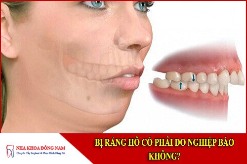 bị răng hô có phải do nghiệp báo không