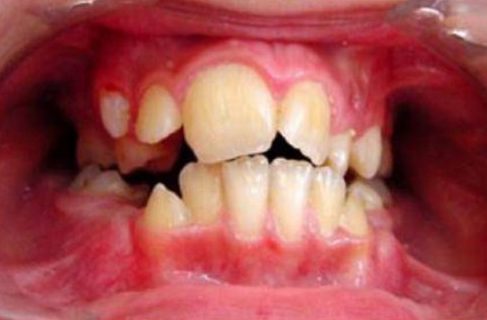 Các giai đoạn điều trị răng bẩm sinh 1
