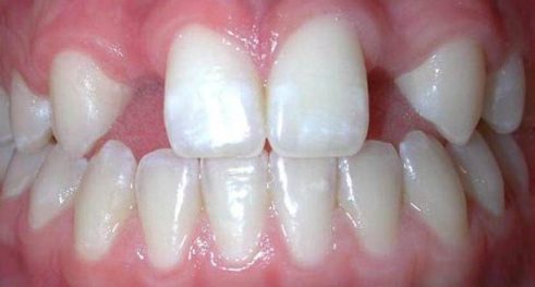 Các giai đoạn điều trị răng bẩm sinh 10