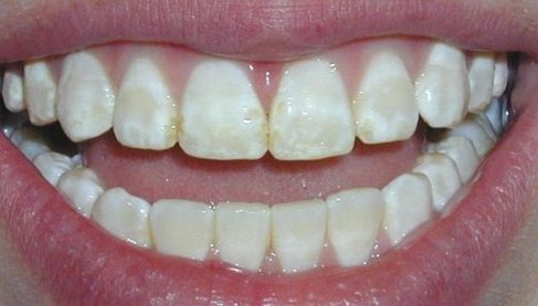 Các giai đoạn điều trị răng bẩm sinh 6