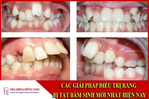 Các giai đoạn điều trị răng bẩm sinh