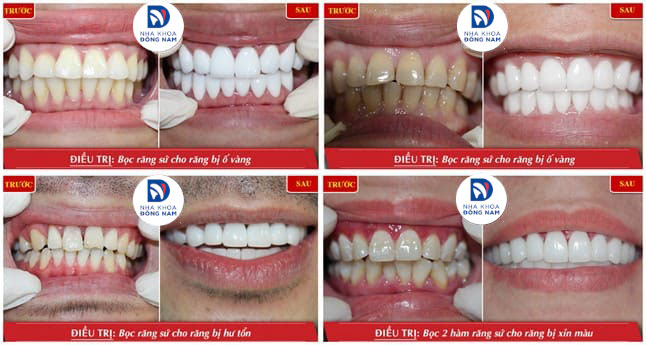 Khách hàng bọc răng sứ hiệu quả tại Nha Khoa Đông Nam