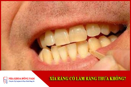 Xỉa răng có làm răng thưa không