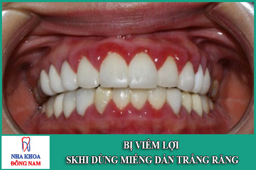 Bị viêm lợi khi dùng miếng dán trắng răng