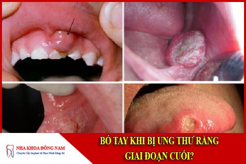 Bó tay khi bị ung thư răng giai đoạn cuối