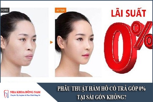 phẫu thuật hàm hô có trả góp 0% tại sài gòn không