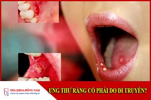 Ung thư răng có phải do di truyền