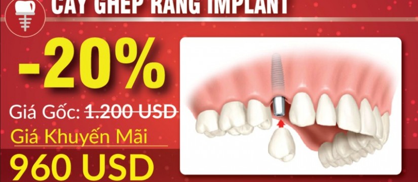 khuyến mãi cấy ghép implant nhân dịp 30/041