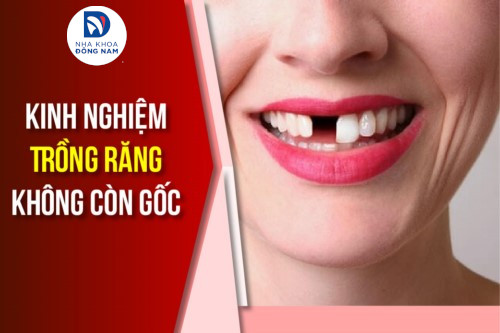 Kinh nghiệm Trồng Răng không còn gốc