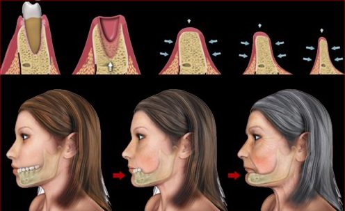 Kinh nghiệm trồng răng không còn gốc 1