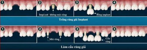 Kinh nghiệm trồng răng không còn gốc 2