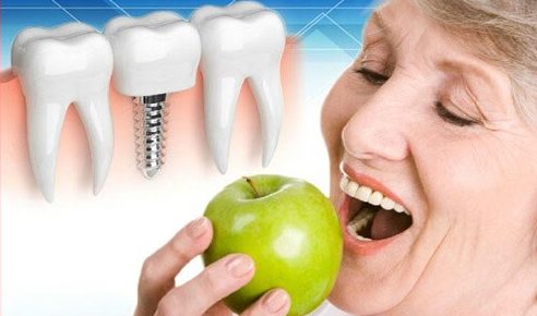 Kinh nghiệm trồng răng không còn gốc 3