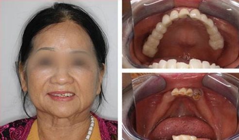 Kinh nghiệm trồng răng không còn gốc 5