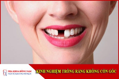 Kinh nghiệm trồng răng không còn gốc