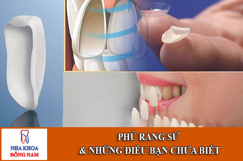 Phủ răng sứ và những điều bạn chưa biết