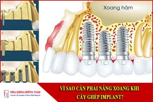 vì sao cần phải nâng xoang khi cấy ghép implant
