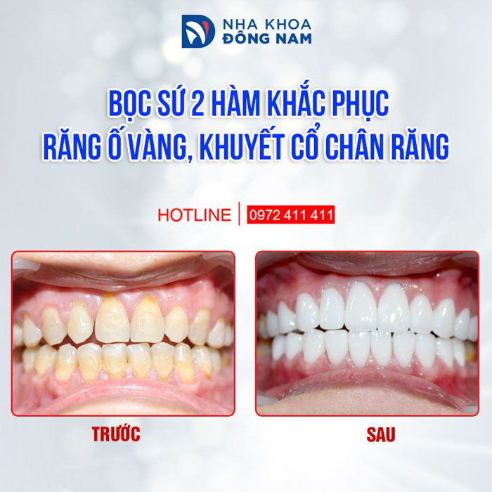 Bọc răng sứ mang lại thẩm mỹ hoàn hảo cho hàm răng