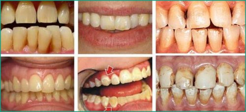 Bột tẩy trắng răng eucryl là gì có nên sử dụng không 4