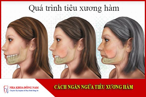 Cách ngăn ngừa tiêu xương hàm
